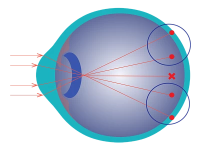 No myopia correction