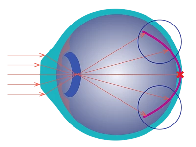 Correction with MoonLens